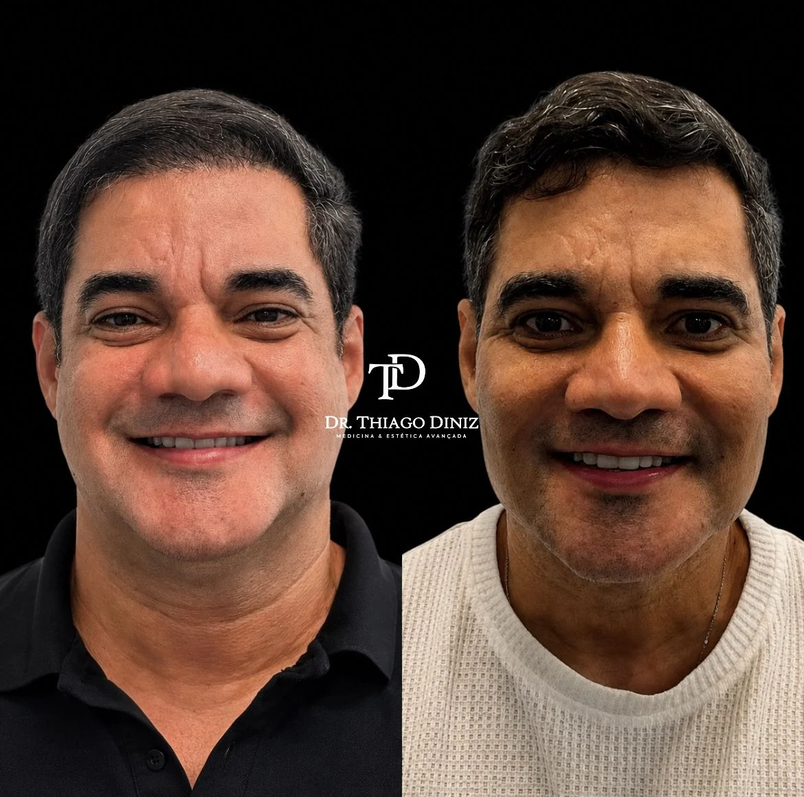 Antes e depois de paciente atendido pelo Dr. Thiago Diniz