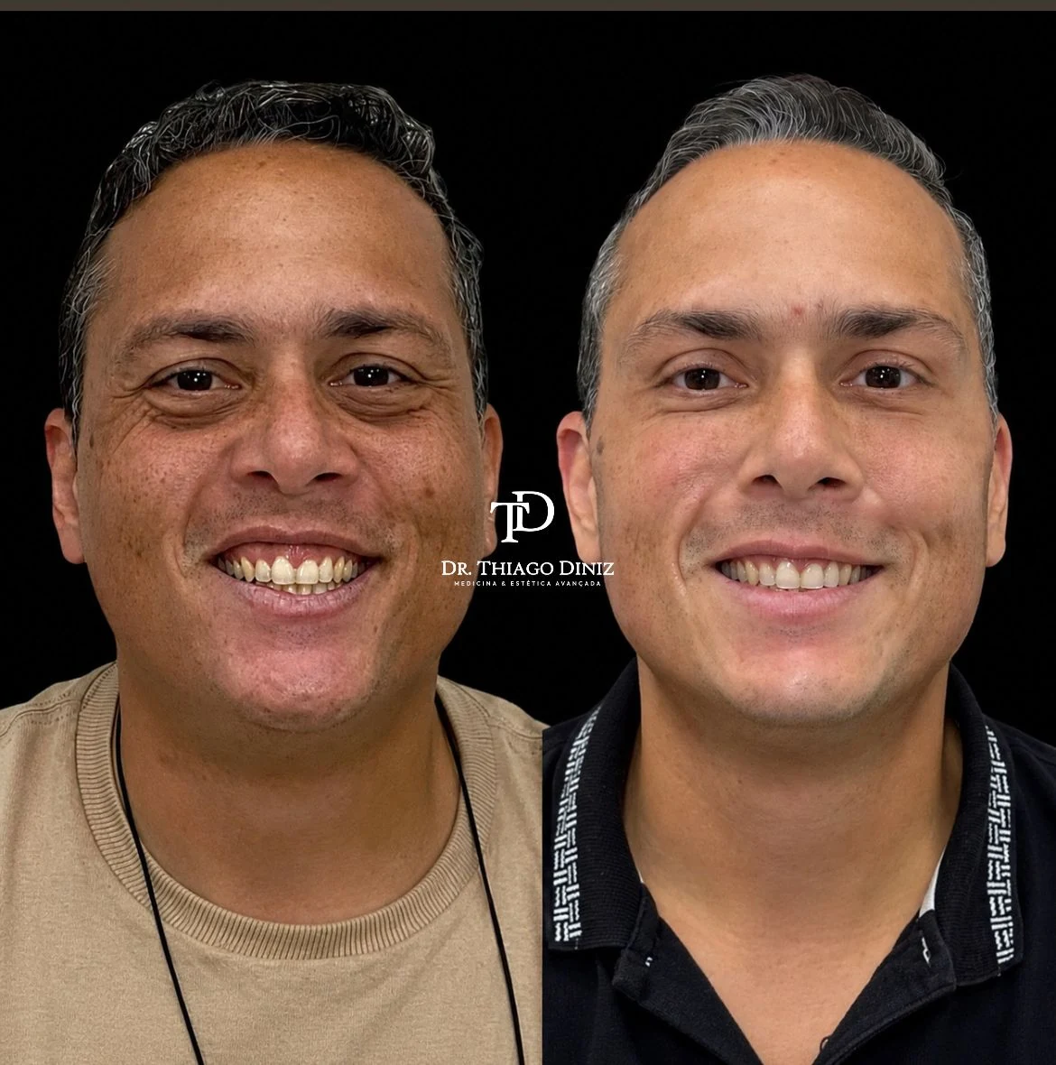 Antes e depois de paciente atendido pelo Dr. Thiago Diniz