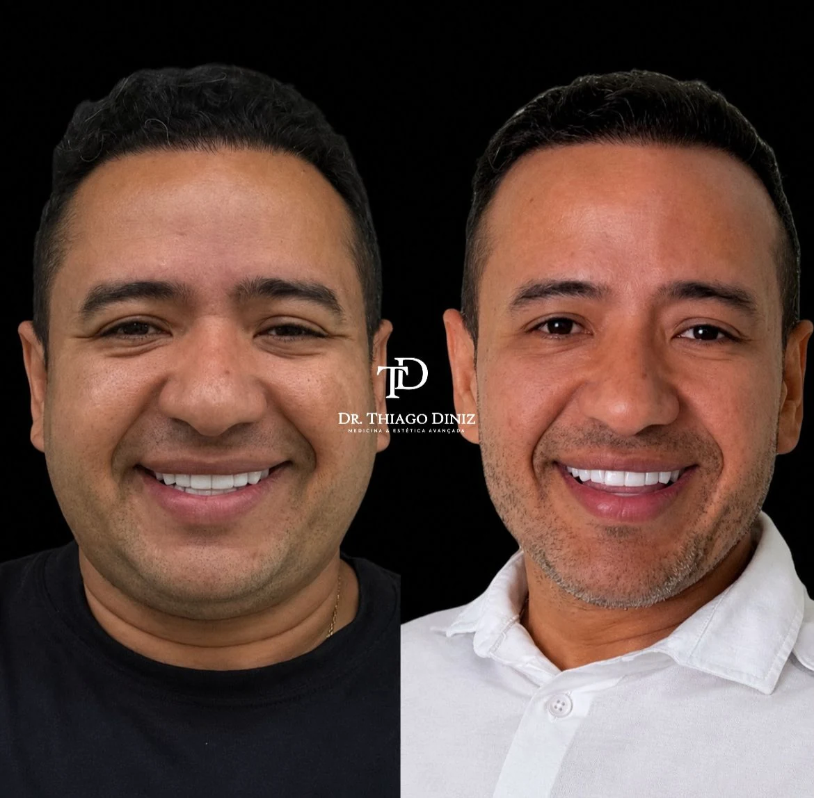 Antes e depois de paciente atendido pelo Dr. Thiago Diniz