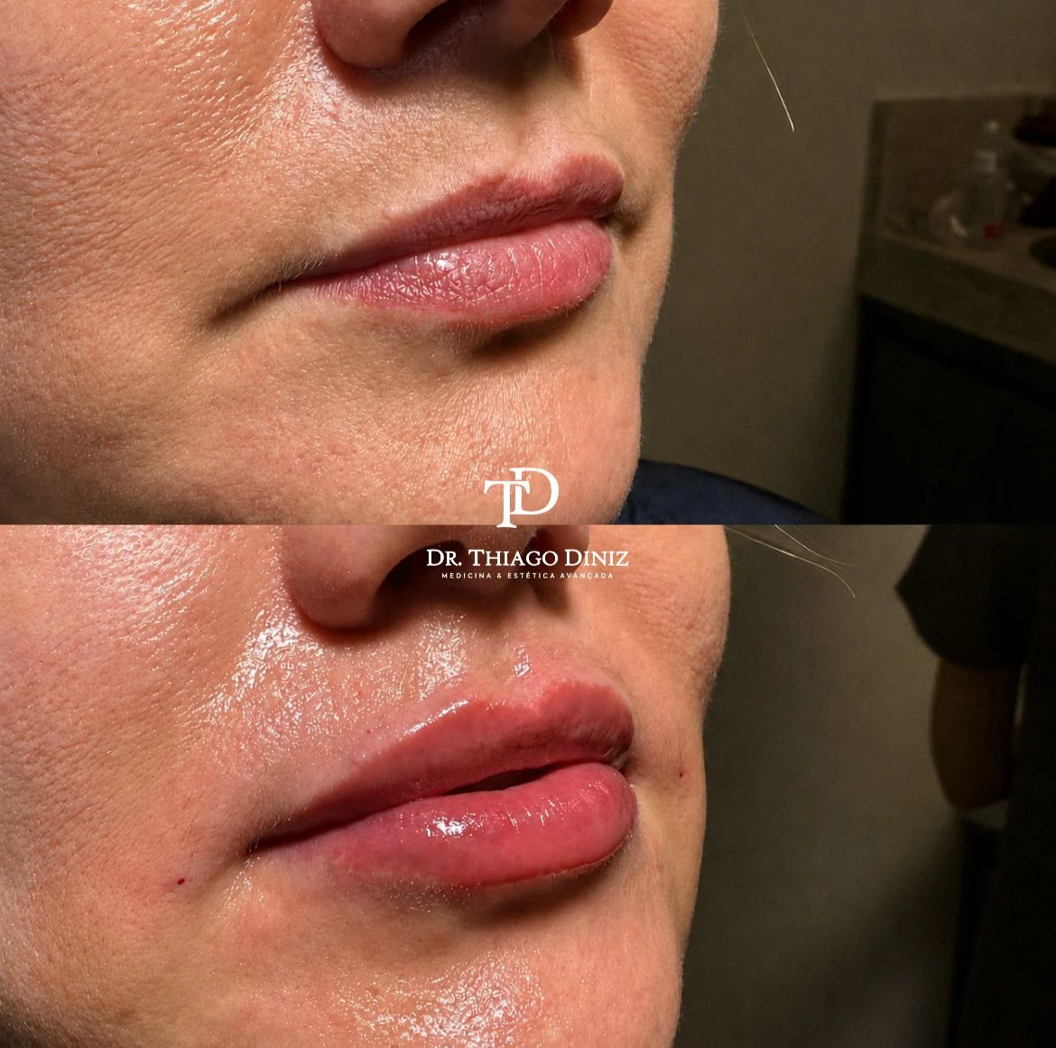 Antes e depois de paciente atendido pelo Dr. Thiago Diniz